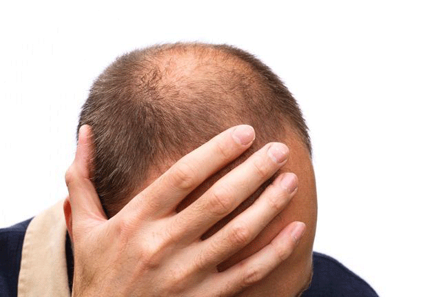 Hair Loss  Harvard Health