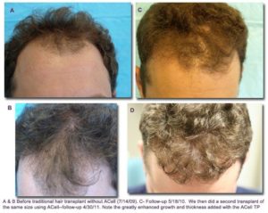 ACell – PRP Case Studies | TrichoStem™ Hair Regeneration New York