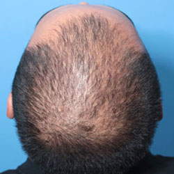 Applied Sciences  Free FullText  Hair Growth Booster Effects of  MicroNeedling with LowLevel Led Therapy and Growth Factors on Subjects  Treated with Finasteridereg