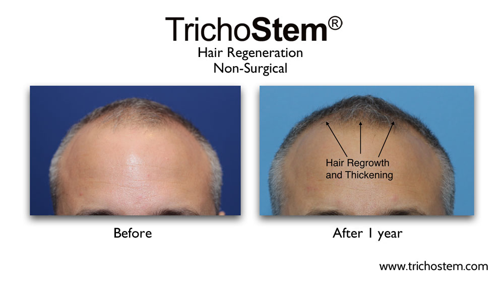 Trichostem Hair Regeneration Case Studies Non Surgical Treatment